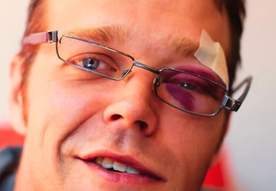 A guy wearing an eyeglasses with a bruised eye.